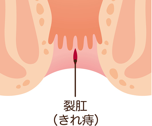 切れ痔