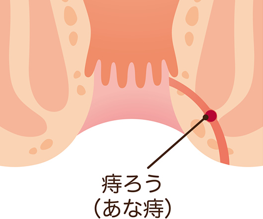 痔ろう